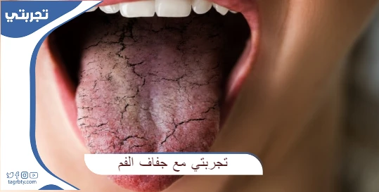 تجربتي مع جفاف الفم والحلق - موقع شملول
