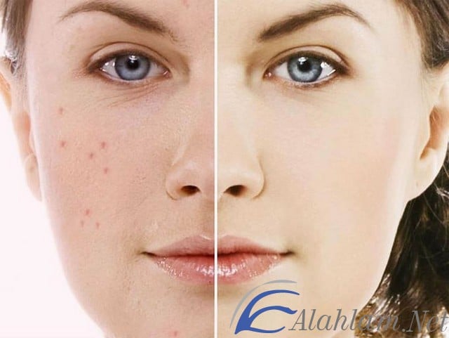 طرق طبيعية للتخلص من آثار حب الشباب