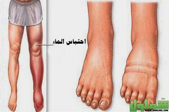 احتباس الماء في الجسم