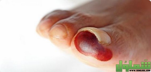 الغرغرينا معدية من شخص لأخر