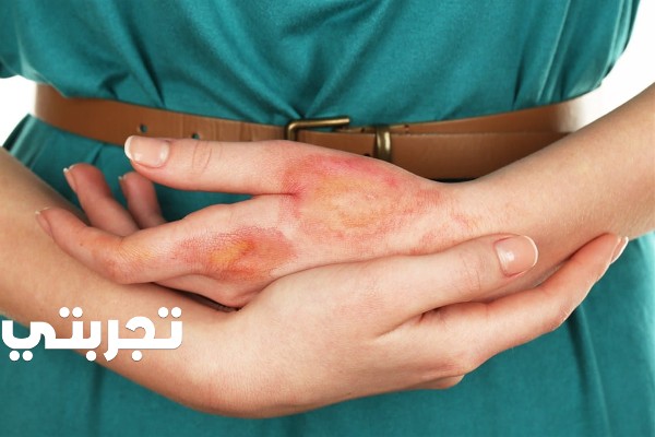 تجاربكم مع حروق الدرجة الثالثة