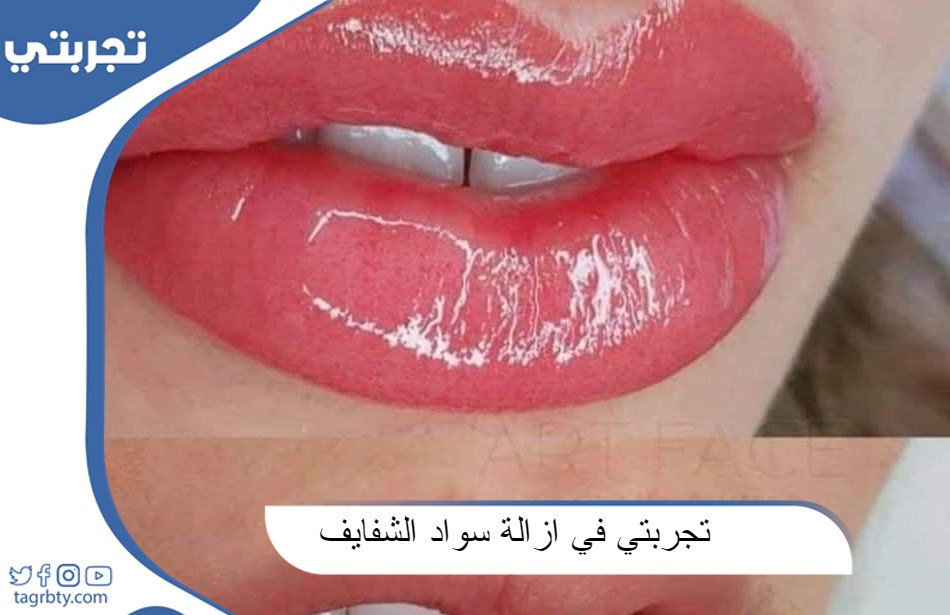 تجربتي في إزالة سواد الشفايف