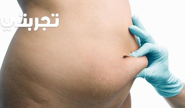 تجربتي في التخلص من الكرش بعد القيصرية