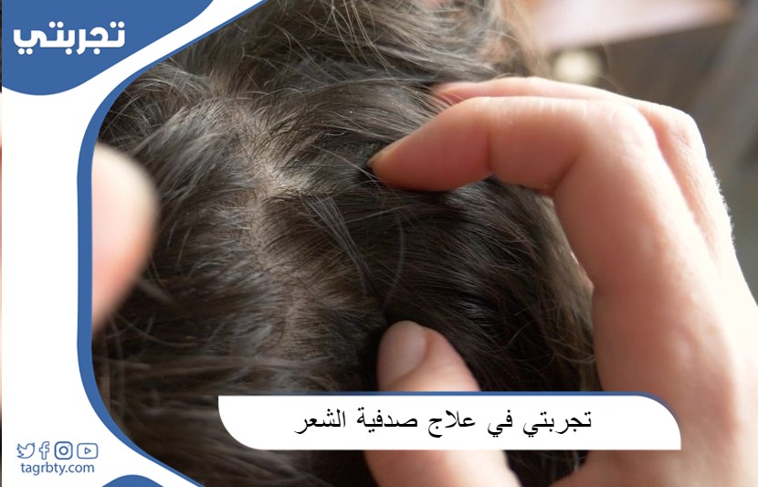 تجربتي في علاج صدفية الشعر