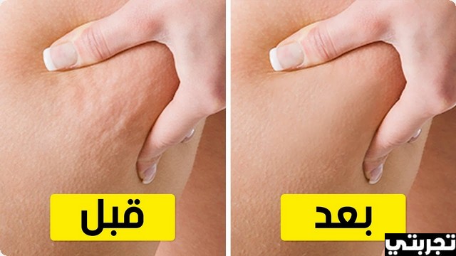 تجربتي مع التخلص من السيلوليت