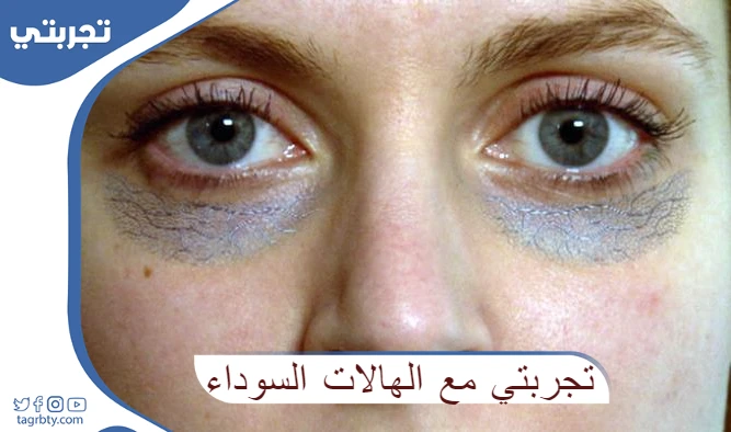 تجربتي مع الهالات السوداء