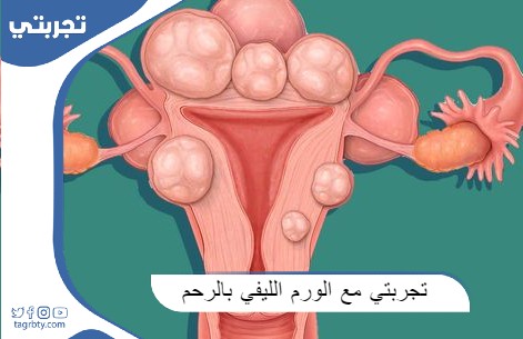 تجربتي مع الورم الليفي بالرحم
