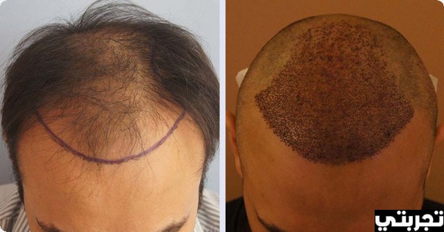 تجربتي مع زراعة الشعر باستخدام تقنية الاقتطاف