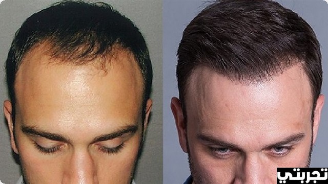 تجربتي مع زراعة الشعر