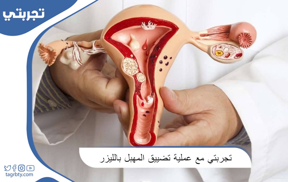 تجربتي مع عملية تضييق المهبل بالليزر