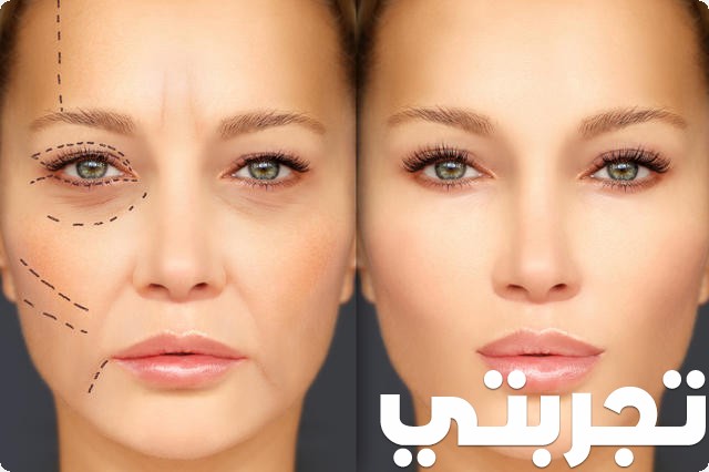 تجربتي مع عملية تكبير وتوسيع العيون