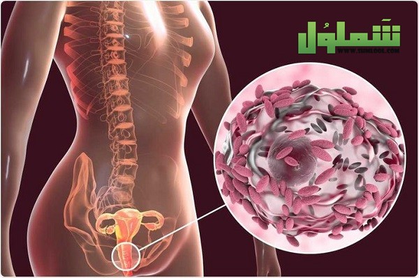 طرق علاج التهابات المهبل للمتزوجات