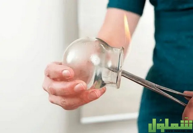 علاج البواسير بالحجامة