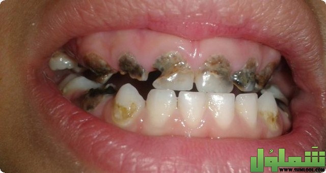 علاج تسوس الاسنان
