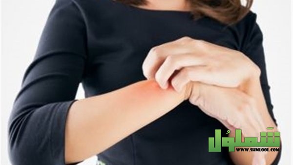 ما هو علاج التينيا الملونة