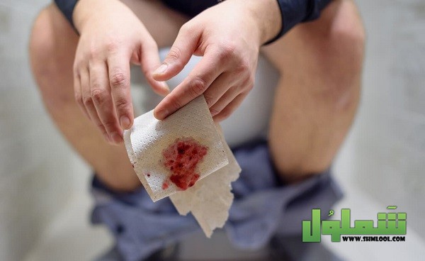 متى يكون نزول الدم مع البراز خطير