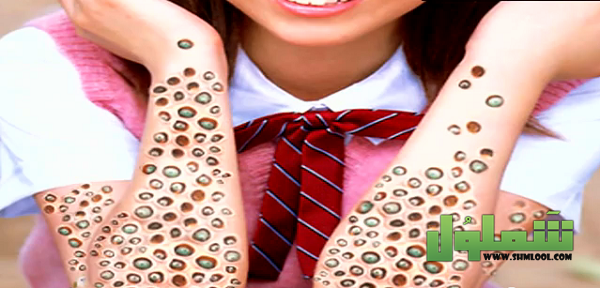 معلومات عن فوبيا الثقوب أو فوبيا النخاريب Trypophobia
